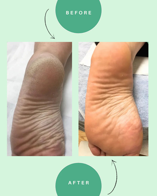 Alroma 42% Urea Foot Repair Stick